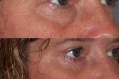 Upper and lower eyelid lift to open the eyes and reduce the puffiness