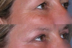 Upper and lower eyelid lift to open the eyes and reduce the puffiness