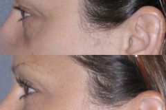 Facial fat transfer to lower eyelids, with upper eyelid lift. Eyes look less tired, more open.