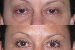 Facial fat transfer to lower eyelids, with upper eyelid lift. Eyes look less tired, more open.