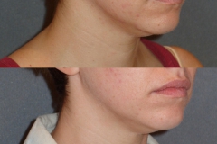 Fractora to the face for acne.