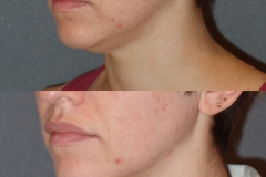 Fractora to the face for acne.