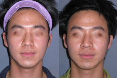 Fraxel dual restore laser skin series for acne scarring