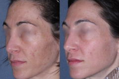 Fraxel dual restore laser skin series for acne scarring.