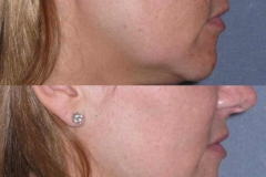 Fraxel restore laser skin series for acne scarring.