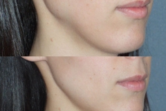 Juvederm treatment of right jawline depression.
