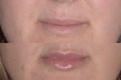Juvederm lip treatment. Lips are shaped, not just filled, for a natural result.