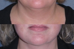 Lower face lift and neck lift