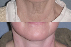 Lower face lift and neck lift