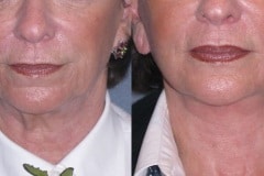 Lower face and neck lift- note elevation of jowls and smoothing of neck bands