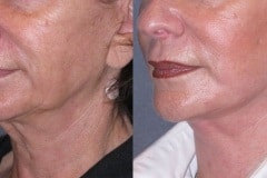 Lower face and neck lift- note elevation of jowls and smoothing of neck bands
