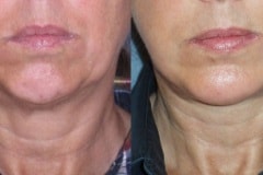 Lower face and neck lift, chin implant- note elevation of jowls and tightening of neck