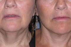 Lower face and neck lift- note elevation of jowls and tightening of neck