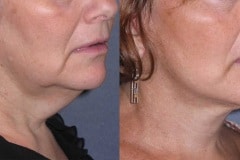 Lower face and neck lift- note elevation of jowls and tightening of neck