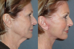 1 Month After Lower Face Neck Lift. Normal Swelling and Bruising
