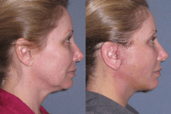 Mini lift with neck lift 1 week after to improve the jawline and neck