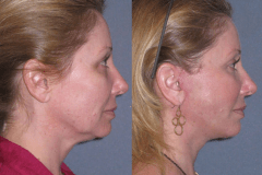 Mini lift with neck lift 2 weeks after to improve the jawline and neck