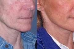 Mini lift with neck lift to improve the jawline and neck