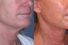 Mini lift with neck lift to improve the jawline and neck
