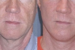 Mini lift with neck lift and chin implant to improve the jawline and neck