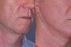 Mini lift with neck lift and chin implant to improve the jawline and neck