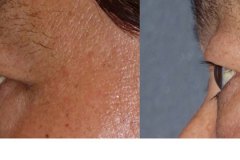 Before and after 1 treatment of upper and lower eyelids with Morpheus. Less puffiness, less hollow, smoother skin.