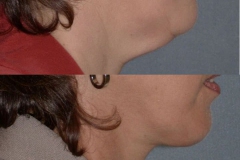 Neck lift note significant improvement in jawline and neck contour