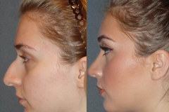 Rhinoplasty cosmetic nasal surgery with septoplasty, narrowing of nose, hump reduction, refinement, deprojection and rotation of the tip.