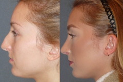 Rhinoplasty cosmetic nasal surgery with septoplasty, narrowing of nose, hump reduction, refinement, deprojection and rotation of the tip.