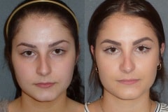 Rhinoplasty (Cosmetic Nasal Surgery) with slight tip refinement and hump reduction. Natural looking result.