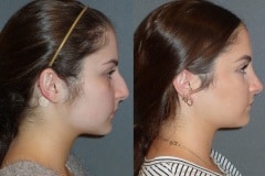 Rhinoplasty (Cosmetic Nasal Surgery) with slight tip refinement and hump reduction. Natural looking result.