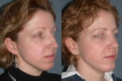 Rhinoplasty (cosmetic nasal surgery) note the natural looking result that does not look "plastic"