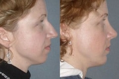 Rhinoplasty (cosmetic nasal surgery) note the natural looking result that does not look "plastic"