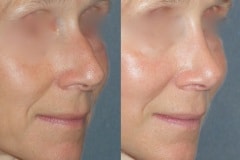 Rhinoplasty (cosmetic nasal surgery) with tip refinement, no rotation, columella correction, hump reduction. Natural looking result