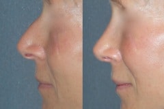Rhinoplasty (cosmetic nasal surgery) with tip refinement, no rotation, columella correction, hump reduction. Natural looking result