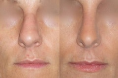 Rhinoplasty (cosmetic nasal surgery) with tip refinement, no rotation, straightening of bridge, slight hump reduction. Natural looking result