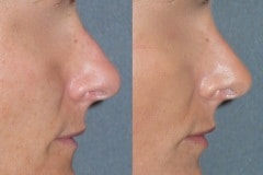 Rhinoplasty (cosmetic nasal surgery) with tip refinement, no rotation, straightening of bridge, slight hump reduction. Natural looking result