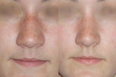 Rhinoplasty (cosmetic nasal surgery) with tip refinement, no rotation, narrowing of nose, slight hump reduction. Natural looking result