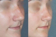 Rhinoplasty (cosmetic nasal surgery) with tip refinement, no rotation, narrowing of nose, slight hump reduction. Natural looking result