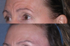 Temporal brow lift that only lifts the outer eyebrow to avoid the surprised look