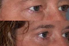 Upper and lower eyelid lift blepharoplasty 1 week after minimal swelling or bruising