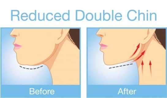 New Non-Surgical Treatment Zaps Away that Double Chin
