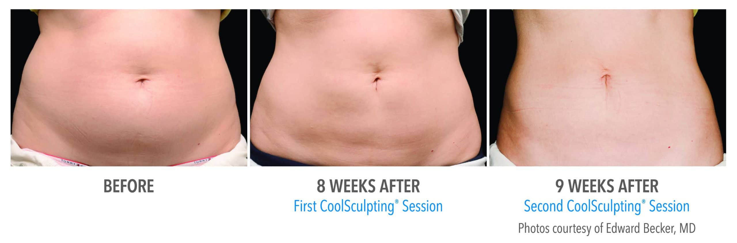 CoolSculpting Before and After Photos