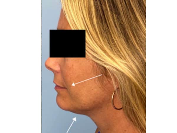 Wrinkle Removal Treatment Results Boston