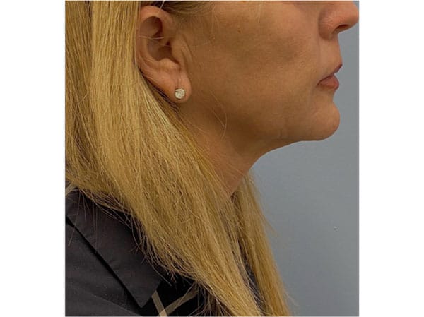 Sofwave non-invasive Wrinkle Removal Results Boston