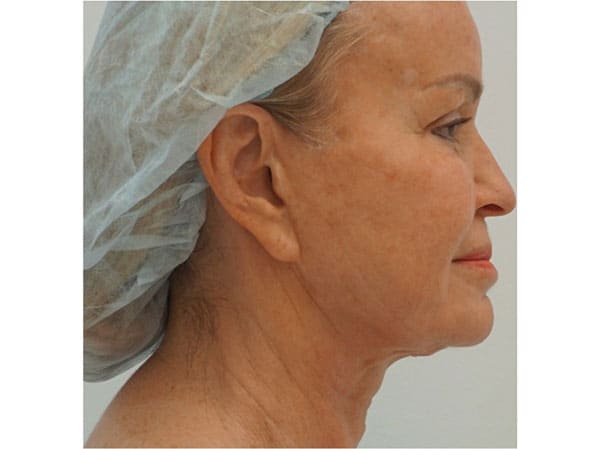 Before Wrinkle Removal Treatment Boston