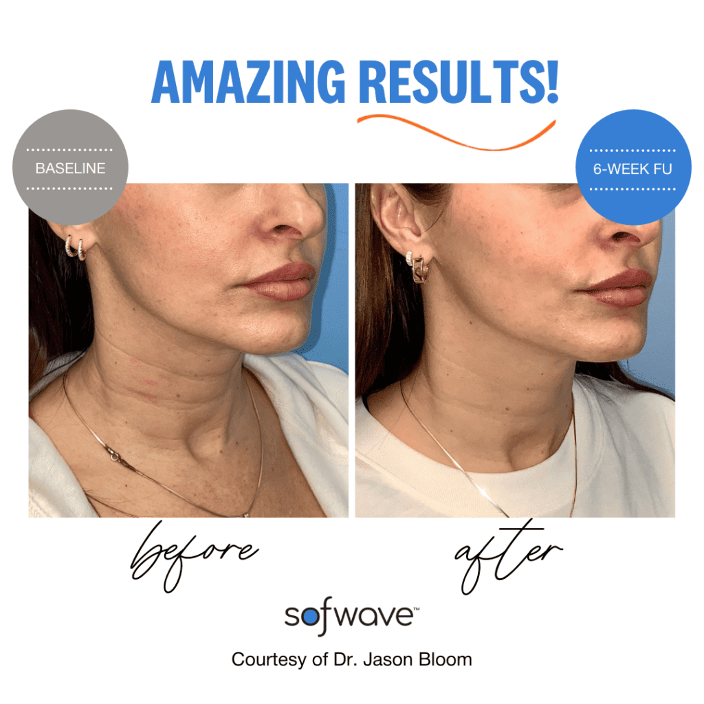 Sofwave Wrinkle Removal Results Boston